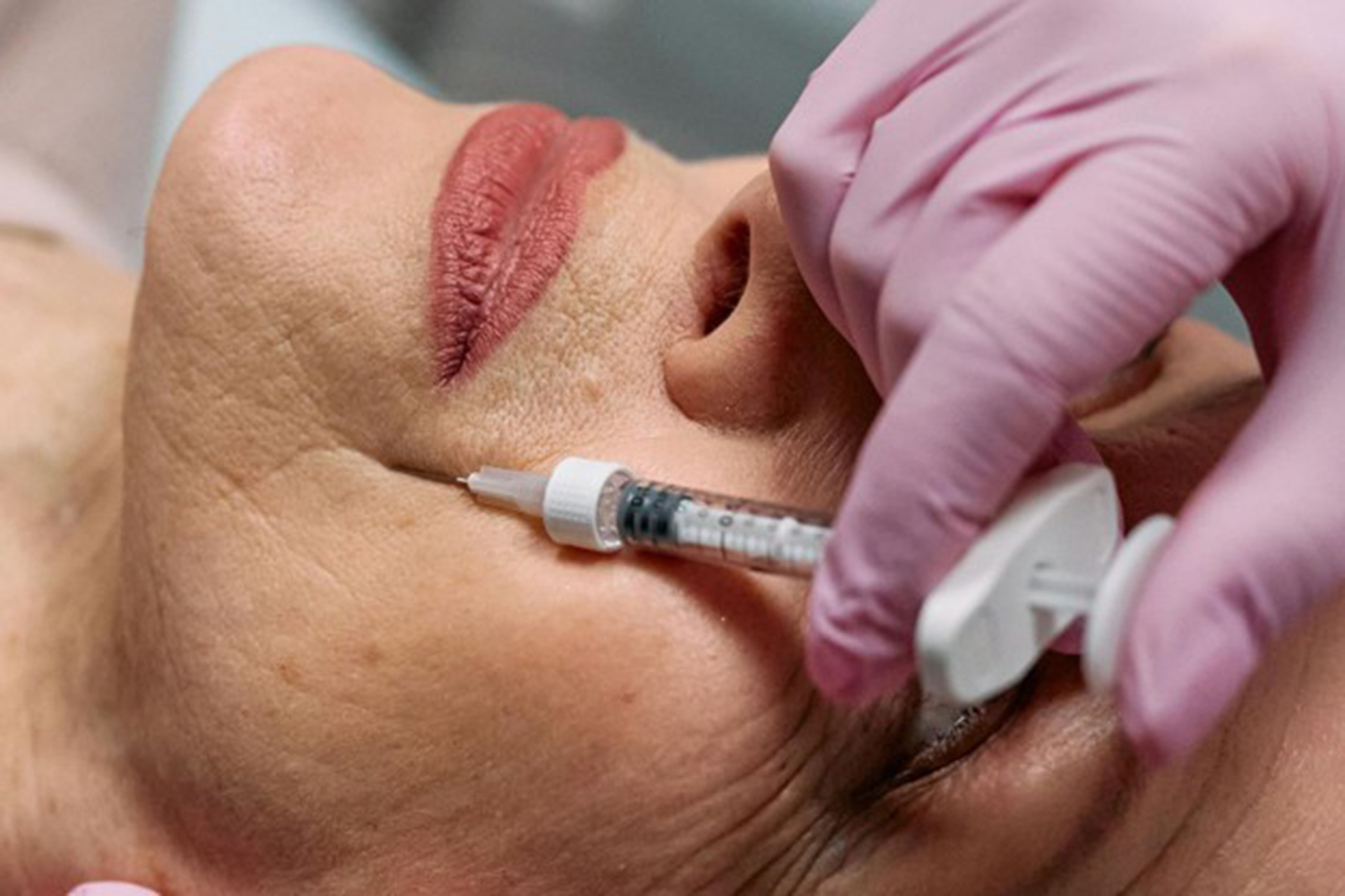 Lip Lift